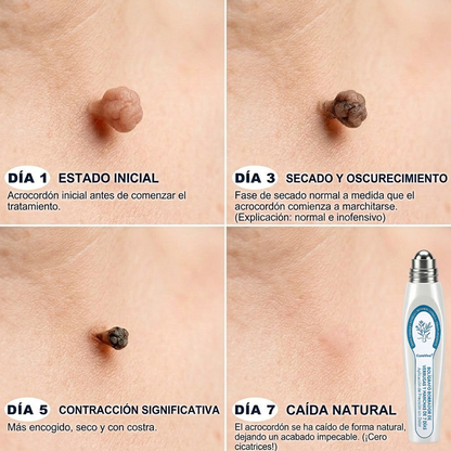 CureVivo® | Tecnología de cuidado de la piel inspirada en dermatología | 🌿🌿Solución de cuidado para acrocordones y manchas en 7 días | 🖊️ Pluma avanzada con aplicador de precisión — Aplicación suave y piel con apariencia más uniforme