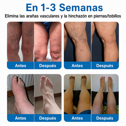 🇲🇽🏆Rollo de parches con microagujas Trilumia® VeinRepair ⚡ Alivio inmediato, resultados a largo plazo