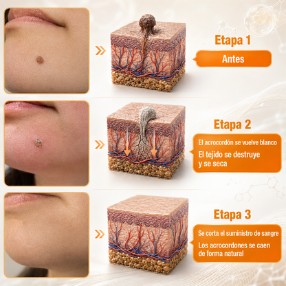 🏆Turonu® Tratamiento Avanzado con Veneno de Abeja para Verrugas e Imperfecciones de la Piel 👨‍⚕️ Inspirado en la ciencia dermatológica | Cuidado localizado desde casa