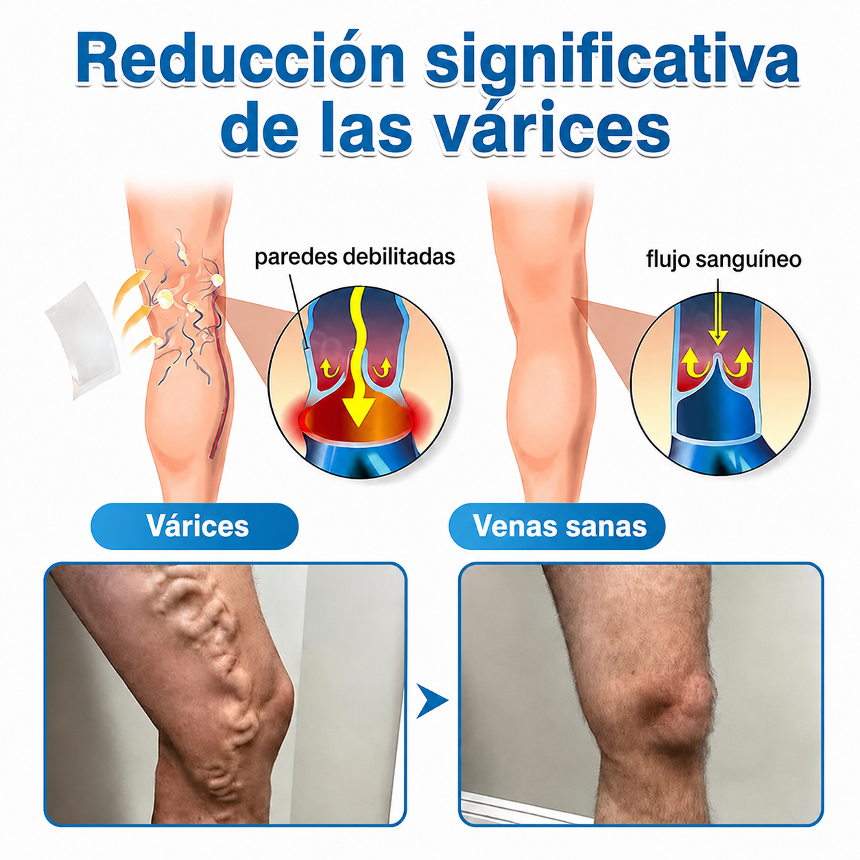 🇲🇽✨ ¿Venas marcadas en tus piernas? Healrize® VeinTarget Parche de Nanomicroagujas para un cuidado avanzado 👩‍⚕️
