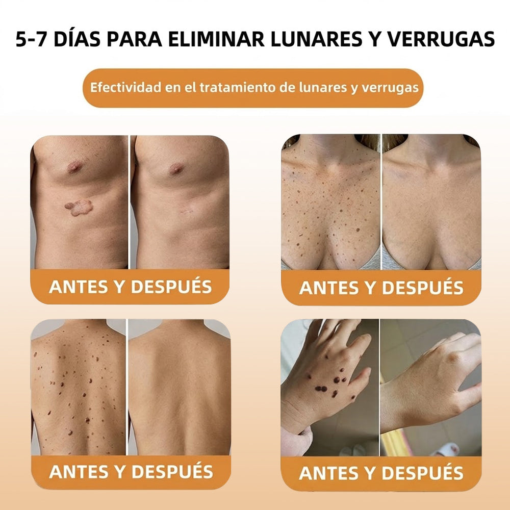 🏆Turonu® Tratamiento Avanzado con Veneno de Abeja para Verrugas e Imperfecciones de la Piel 👨‍⚕️ Inspirado en la ciencia dermatológica | Cuidado localizado desde casa
