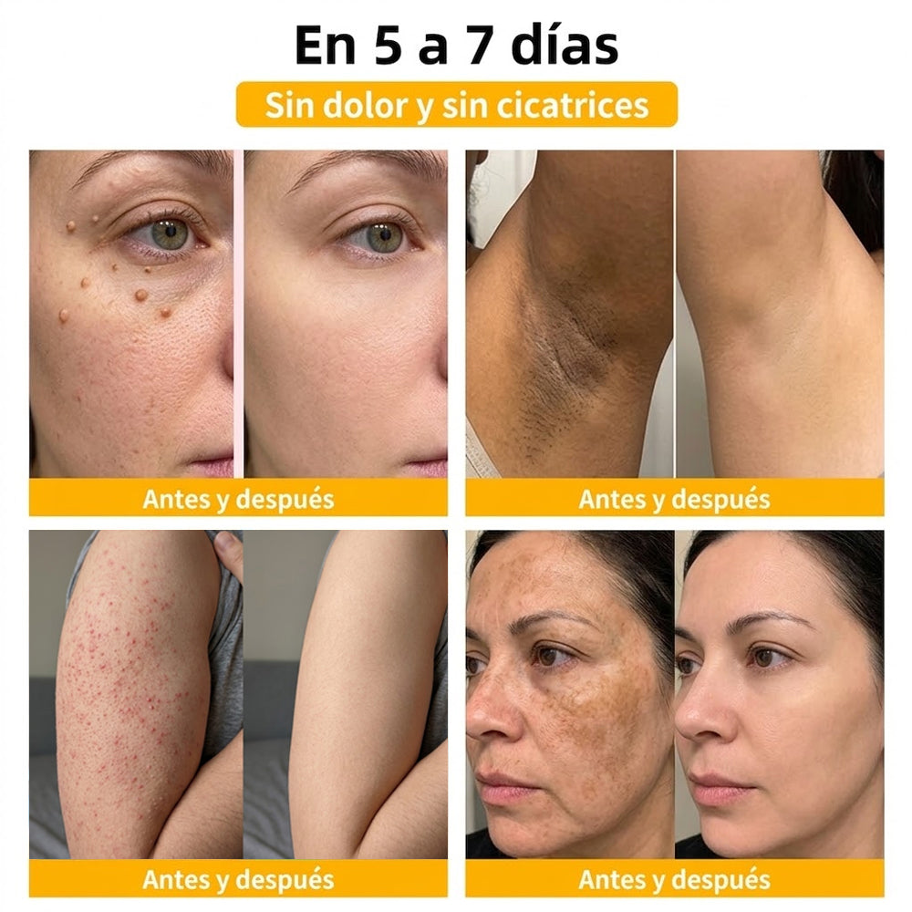 🏆Turonu® Tratamiento Avanzado con Veneno de Abeja para Verrugas e Imperfecciones de la Piel 👨‍⚕️ Inspirado en la ciencia dermatológica | Cuidado localizado desde casa