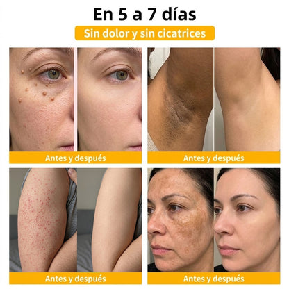 🏆Turonu® Tratamiento Avanzado con Veneno de Abeja para Verrugas e Imperfecciones de la Piel 👨‍⚕️ Inspirado en la ciencia dermatológica | Cuidado localizado desde casa