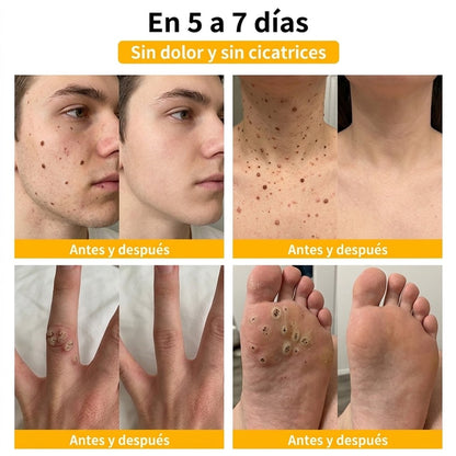 🏆Turonu® Tratamiento Avanzado con Veneno de Abeja para Verrugas e Imperfecciones de la Piel 👨‍⚕️ Inspirado en la ciencia dermatológica | Cuidado localizado desde casa