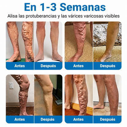🇲🇽✨ ¿Venas marcadas en tus piernas? Healrize® VeinTarget Parche de Nanomicroagujas para un cuidado avanzado 👩‍⚕️