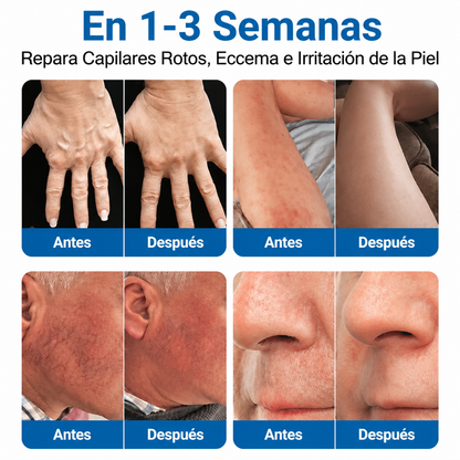 🇲🇽🏆Rollo de parches con microagujas Trilumia® VeinRepair ⚡ Alivio inmediato, resultados a largo plazo