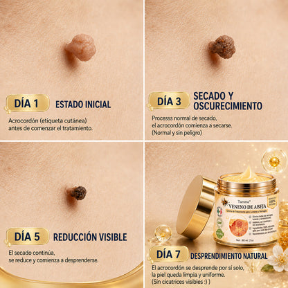 🧚‍♀️Turonu® tratamiento avanzado con veneno de abeja contra las verrugas y las imperfecciones de la piel 👨‍⚕️ Inspirado en la ciencia dermatológica | Cuidado localizado en casa