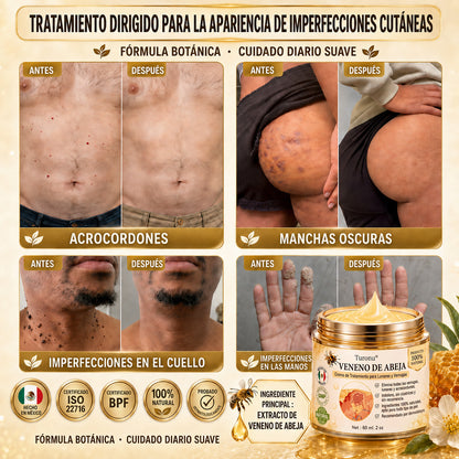 Turonu®🎇 tratamiento avanzado con veneno de abeja contra las verrugas y las imperfecciones de la piel 👨‍⚕️ Inspirado en la ciencia dermatológica | Cuidado localizado en casa