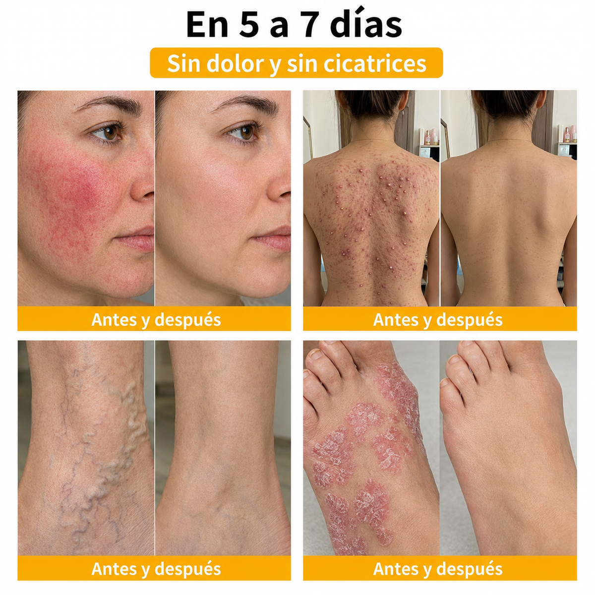 🏆Turonu® Tratamiento Avanzado con Veneno de Abeja para Verrugas e Imperfecciones de la Piel 👨‍⚕️ Inspirado en la ciencia dermatológica | Cuidado localizado desde casa