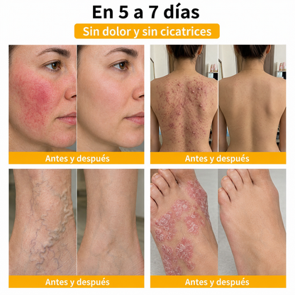 🏆Turonu® Tratamiento Avanzado con Veneno de Abeja para Verrugas e Imperfecciones de la Piel 👨‍⚕️ Inspirado en la ciencia dermatológica | Cuidado localizado desde casa