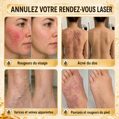 Turonu®🖼️tratamiento avanzado con veneno de abeja contra las verrugas y las imperfecciones de la piel 👨‍⚕️ Inspirado en la ciencia dermatológica | Cuidado localizado en casa