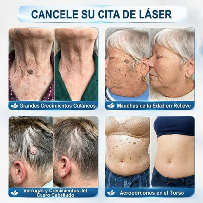 CureVivo® | Tecnología de cuidado de la piel inspirada en dermatología | 🌿🌿Solución de cuidado para acrocordones y manchas en 7 días | 🖊️ Pluma avanzada con aplicador de precisión — Aplicación suave y piel con apariencia más uniforme