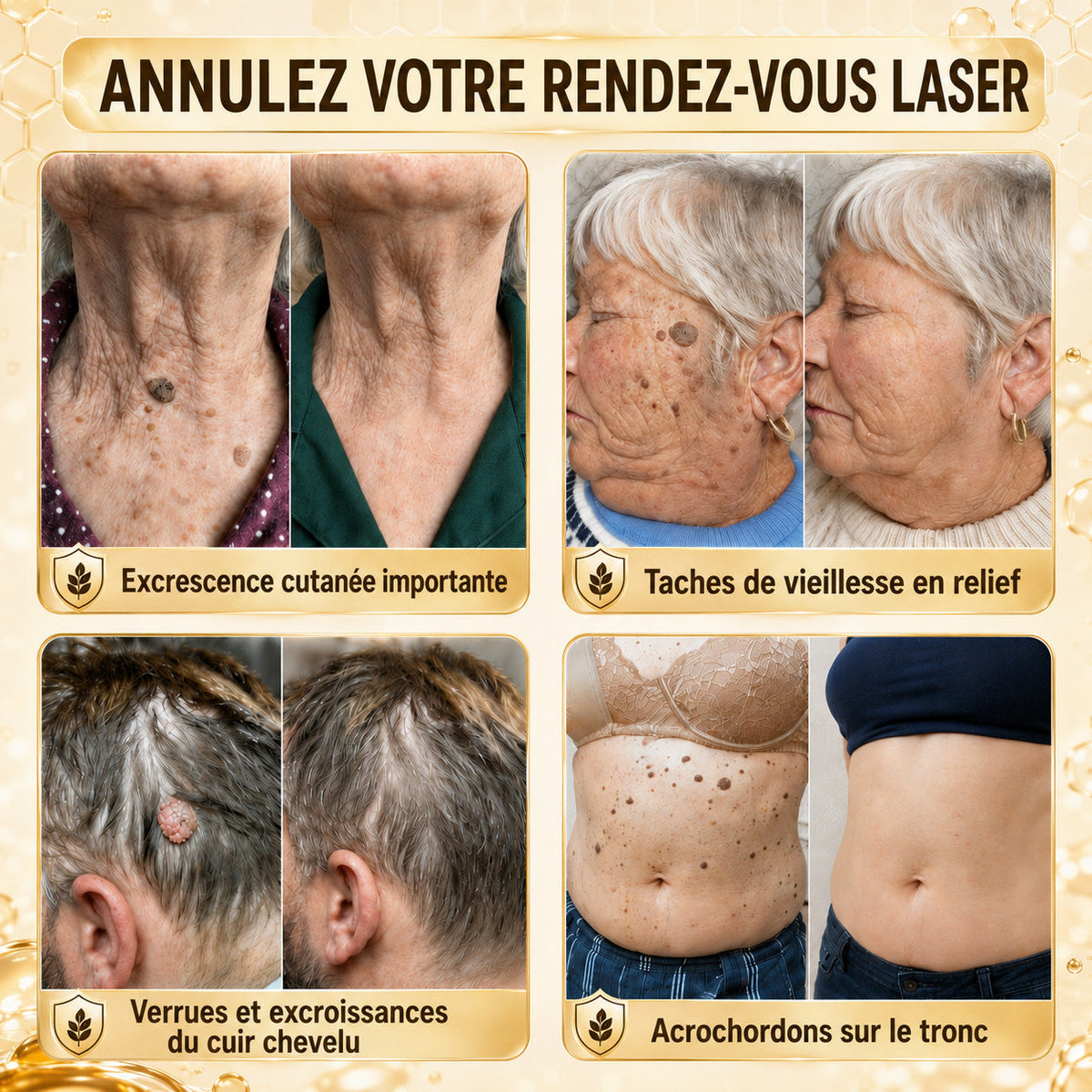 Turonu®🎉 tratamiento avanzado con veneno de abeja contra las verrugas y las imperfecciones de la piel 👨‍⚕️ Inspirado en la ciencia dermatológica | Cuidado localizado en casa