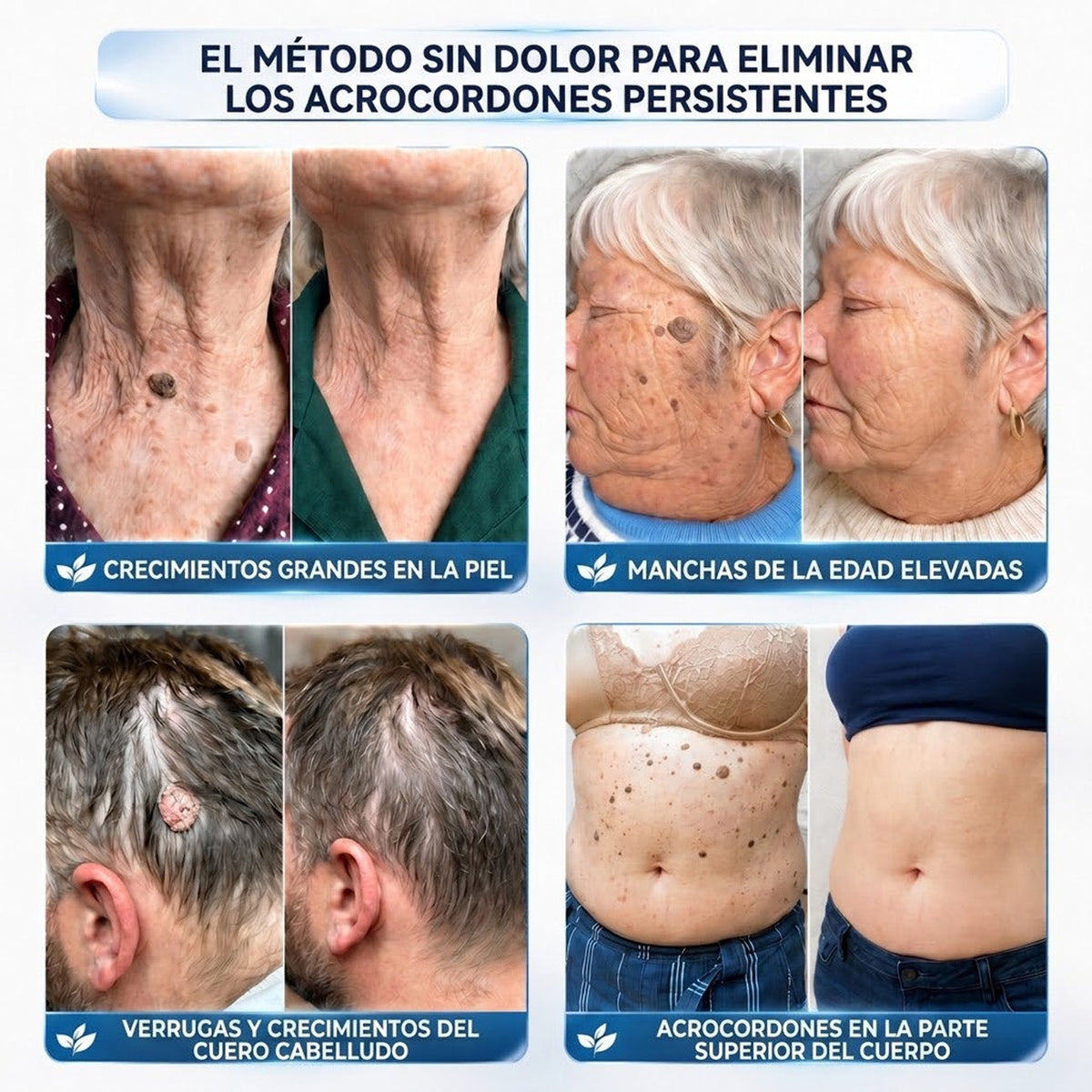 🏆CureVivo® Crema Eliminadora de Etiquetas y Manchas Cutáneas 7 Días (Fórmula Indolora – Sin Cicatrices)🤗