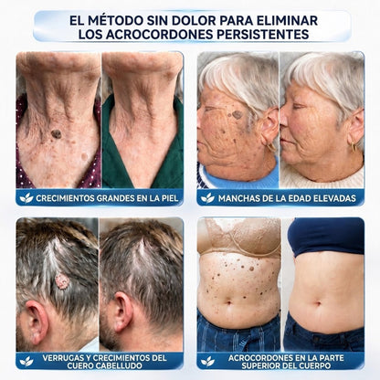 🏆CureVivo® Crema Eliminadora de Etiquetas y Manchas Cutáneas 7 Días (Fórmula Indolora – Sin Cicatrices)🤗