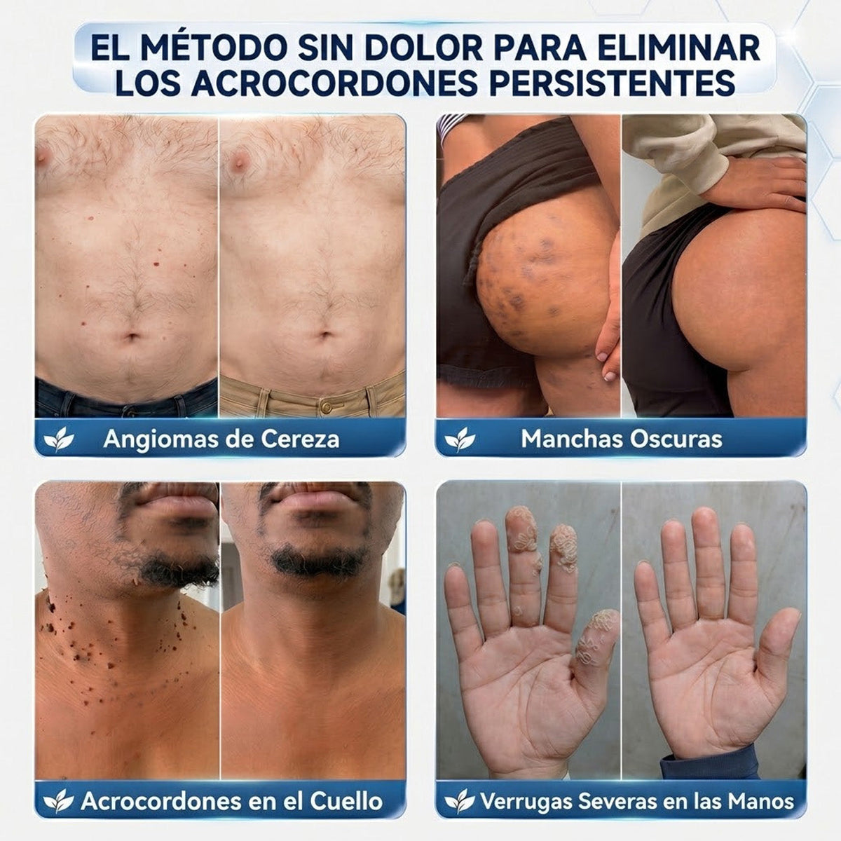 🏆CureVivo® Crema Eliminadora de Etiquetas y Manchas Cutáneas 7 Días (Fórmula Indolora – Sin Cicatrices)🤗