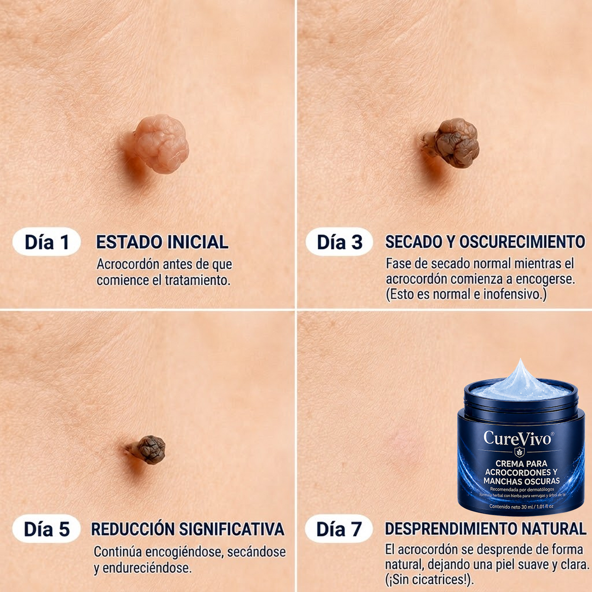 🏆CureVivo® Crema Eliminadora de Etiquetas y Manchas Cutáneas 7 Días (Fórmula Indolora – Sin Cicatrices)🤗
