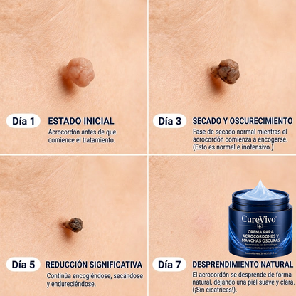 🏆CureVivo® Crema Eliminadora de Etiquetas y Manchas Cutáneas 7 Días (Fórmula Indolora – Sin Cicatrices)🤗
