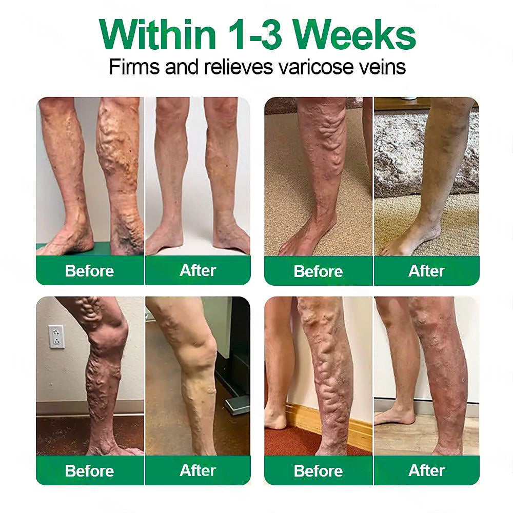 🇺🇸🦅✅Healrize® VeinTarget Microneedle Patch⚡Instant Relief, Long-Term Results 👩‍⚕️