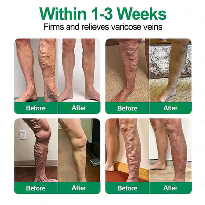 🇺🇸🦅✅Healrize® VeinTarget Microneedle Patch⚡Instant Relief, Long-Term Results 👩‍⚕️