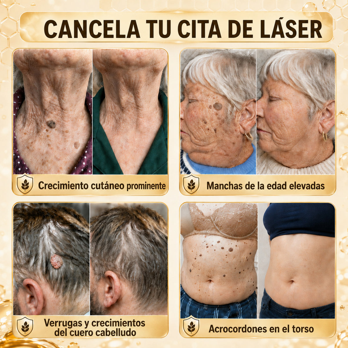 Turonu®🖼️tratamiento avanzado con veneno de abeja contra las verrugas y las imperfecciones de la piel 👨‍⚕️ Inspirado en la ciencia dermatológica | Cuidado localizado en casa