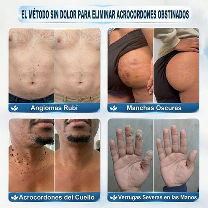 CureVivo® | Tecnología de cuidado de la piel inspirada en dermatología | 🌿🌿Solución de cuidado para acrocordones y manchas en 7 días | 🖊️ Pluma avanzada con aplicador de precisión — Aplicación suave y piel con apariencia más uniforme