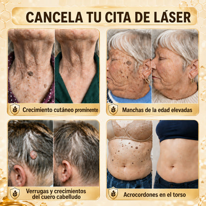 Turonu®🎇 tratamiento avanzado con veneno de abeja contra las verrugas y las imperfecciones de la piel 👨‍⚕️ Inspirado en la ciencia dermatológica | Cuidado localizado en casa