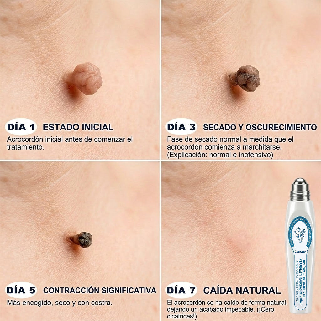 Instalación registrada ante COFEPRIS丨🩺 Eliminador de acrocordones y manchas en 7 días Pluma roll-on avanzada, sin dolor y sin dejar cicatrices