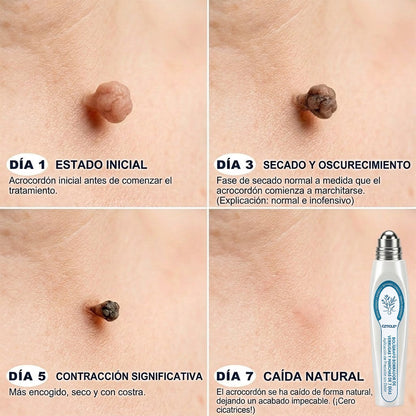 Instalación registrada ante COFEPRIS丨🩺 Eliminador de acrocordones y manchas en 7 días Pluma roll-on avanzada, sin dolor y sin dejar cicatrices
