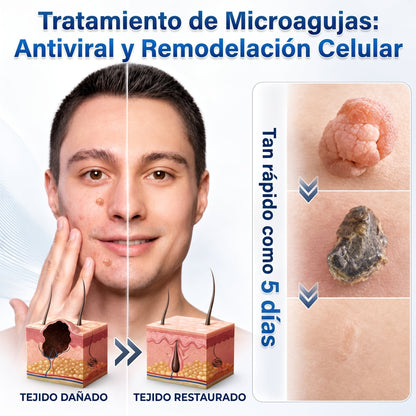 👩‍⚕️🎉𝑻𝒊𝒆𝒏𝒅𝒂 𝑶𝒇𝒊𝒄𝒊𝒂𝒍 | CZTICLE® ☃️ 𝑀𝑖𝑐𝑟𝑜𝑎𝑔𝑢𝑗𝑎𝑠 𝑃𝑖𝑒𝑙 𝐼𝑚𝑝𝑒𝑐𝑎𝑏𝑙𝑒 𝐸𝑙𝑖𝑚𝑖𝑛𝑎𝑐𝑖ó𝑛 𝐷𝑒 𝑉𝑒𝑟𝑟𝑢𝑔𝑎𝑠 𝑃𝑎𝑟𝑐ℎ𝑒 (𝑃𝑎𝑟𝑎 𝑎𝑐𝑟𝑜𝑐𝑜𝑟𝑑𝑜𝑛𝑒𝑠, 𝑝𝑒𝑞𝑢𝑒ñ𝑎𝑠 𝑖𝑚𝑝𝑒𝑟𝑓𝑒𝑐𝑐𝑖𝑜𝑛𝑒𝑠 𝑐𝑢𝑡á𝑛𝑒𝑎𝑠, 𝑣𝑒𝑟𝑟𝑢𝑔𝑎𝑠, 𝑙𝑢𝑛𝑎𝑟𝑒𝑠, 𝑚𝑎𝑛𝑐ℎ𝑎𝑠 𝑑𝑒 𝑙𝑎 𝑒𝑑𝑎𝑑 𝑦 𝑝𝑟𝑜𝑏𝑙𝑒𝑚𝑎𝑠 𝑑𝑒 𝑝𝑖𝑔𝑚𝑒𝑛𝑡𝑎𝑐𝑖ó𝑛.)