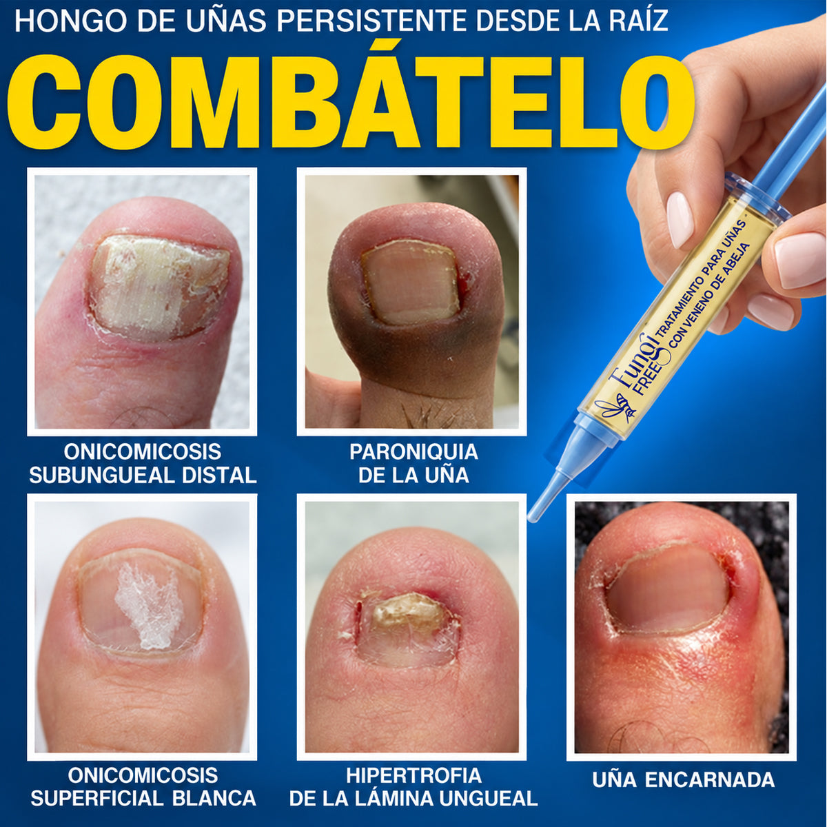 🇲🇽 Turonu® FungiFree 🐝 Cuidado Intensivo para Hongos, Uñas Amarillas, Gruesas y Quebradizas ✨