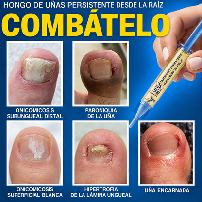 🇲🇽 Turonu® FungiFree 🐝 Cuidado Intensivo para Hongos, Uñas Amarillas, Gruesas y Quebradizas ✨