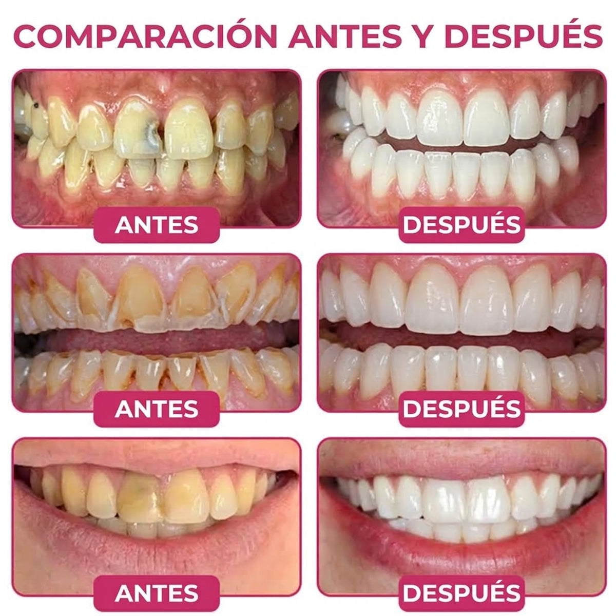 🪥GarageLine®💡 DenPerm Gel para Reparar Caries y Restaurar el Esmalte Dental🪥