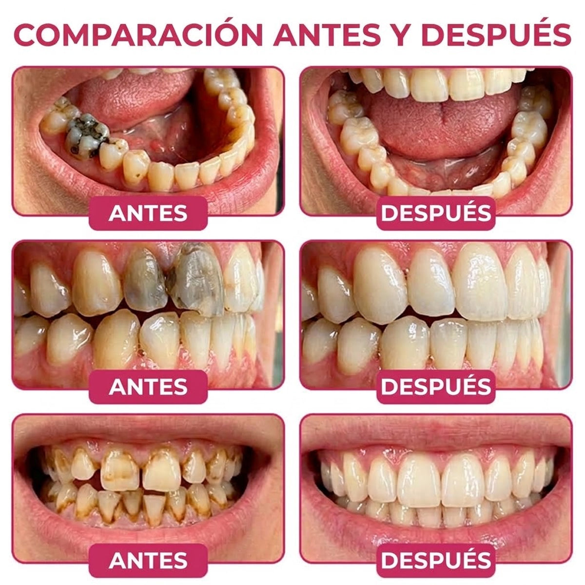 🪥GarageLine®💡 DenPerm Gel para Reparar Caries y Restaurar el Esmalte Dental🪥