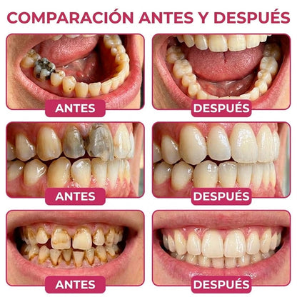 🪥GarageLine®💡 DenPerm Gel para Reparar Caries y Restaurar el Esmalte Dental🪥