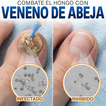 🇲🇽 Turonu® FungiFree 🐝 Cuidado Intensivo para Hongos, Uñas Amarillas, Gruesas y Quebradizas ✨