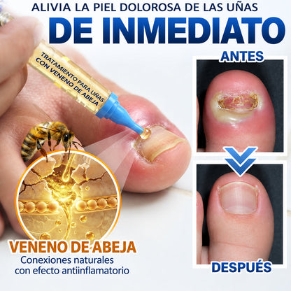 🇲🇽 Turonu® FungiFree 🐝 Cuidado Intensivo para Hongos, Uñas Amarillas, Gruesas y Quebradizas ✨