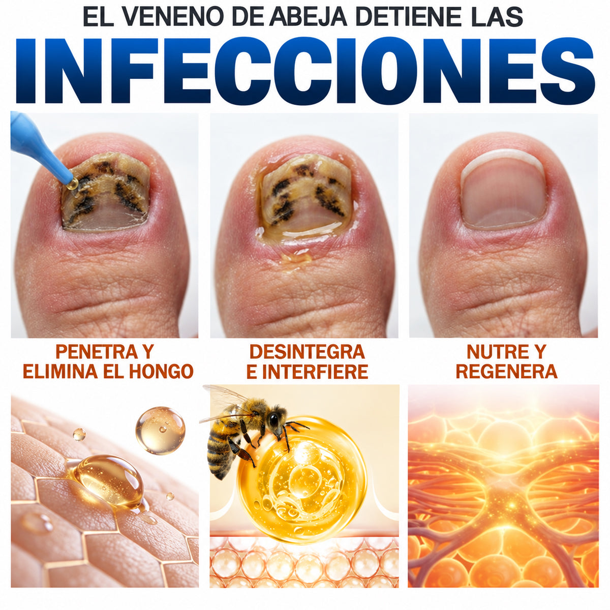 🇲🇽 Turonu® FungiFree 🐝 Cuidado Intensivo para Hongos, Uñas Amarillas, Gruesas y Quebradizas ✨