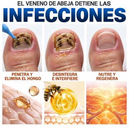 🇲🇽 Turonu® FungiFree 🐝 Cuidado Intensivo para Hongos, Uñas Amarillas, Gruesas y Quebradizas ✨