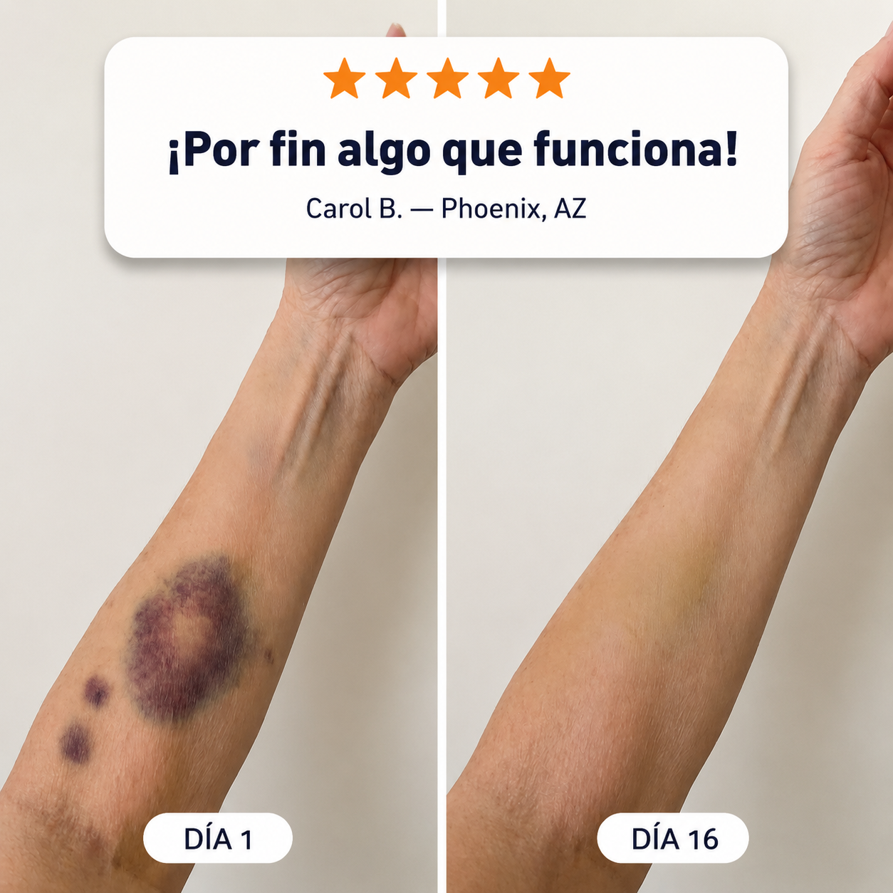 💥¡Más de 100,000 vendidos!💕- CureVivo® Crema Reparadora de Moretones y Fortalecedora de la Piel