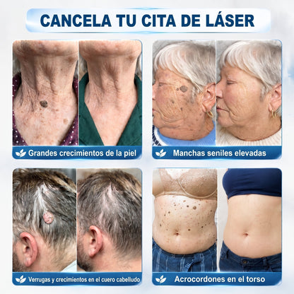 👩‍⚕️🎉𝑻𝒊𝒆𝒏𝒅𝒂 𝑶𝒇𝒊𝒄𝒊𝒂𝒍 | CZTICLE® ☃️ 𝑀𝑖𝑐𝑟𝑜𝑎𝑔𝑢𝑗𝑎𝑠 𝑃𝑖𝑒𝑙 𝐼𝑚𝑝𝑒𝑐𝑎𝑏𝑙𝑒 𝐸𝑙𝑖𝑚𝑖𝑛𝑎𝑐𝑖ó𝑛 𝐷𝑒 𝑉𝑒𝑟𝑟𝑢𝑔𝑎𝑠 𝑃𝑎𝑟𝑐ℎ𝑒 (𝑃𝑎𝑟𝑎 𝑎𝑐𝑟𝑜𝑐𝑜𝑟𝑑𝑜𝑛𝑒𝑠, 𝑝𝑒𝑞𝑢𝑒ñ𝑎𝑠 𝑖𝑚𝑝𝑒𝑟𝑓𝑒𝑐𝑐𝑖𝑜𝑛𝑒𝑠 𝑐𝑢𝑡á𝑛𝑒𝑎𝑠, 𝑣𝑒𝑟𝑟𝑢𝑔𝑎𝑠, 𝑙𝑢𝑛𝑎𝑟𝑒𝑠, 𝑚𝑎𝑛𝑐ℎ𝑎𝑠 𝑑𝑒 𝑙𝑎 𝑒𝑑𝑎𝑑 𝑦 𝑝𝑟𝑜𝑏𝑙𝑒𝑚𝑎𝑠 𝑑𝑒 𝑝𝑖𝑔𝑚𝑒𝑛𝑡𝑎𝑐𝑖ó𝑛.)